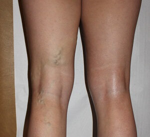 My legs prior to the use of the NanoVein