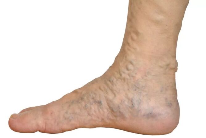 Veen's illness on the legs