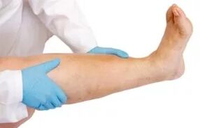 The lower limb swelling