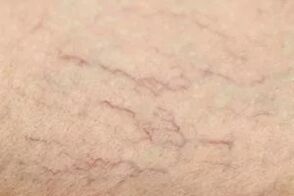 Vascular stars