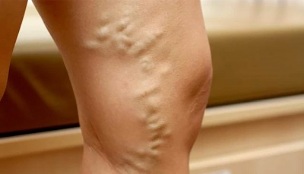 the cause of varicose veins in women
