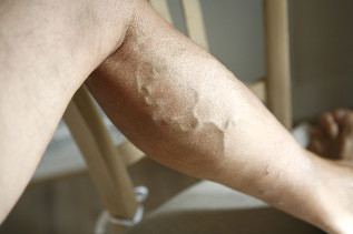 what is varicose veins is forbidden