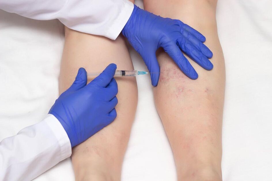 Sclerotherapy is one way to treat varicose veins