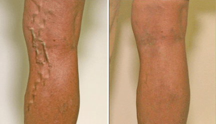varicose veins in the 1st and 3rd stages of development