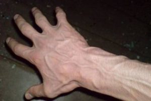 methods of treating varicose veins in the hands