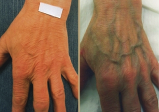 the cause of varicose veins in the hands