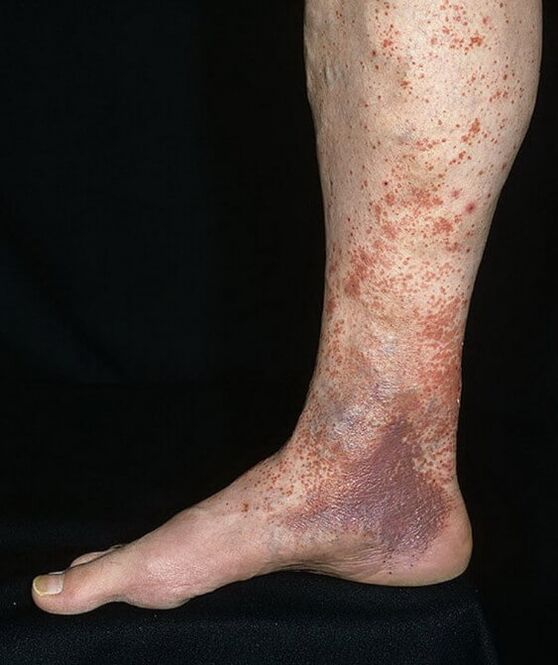 Varicose vein dermatitis
