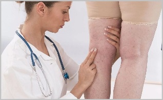 A woman turned to a doctor with clear signs of varicose veins
