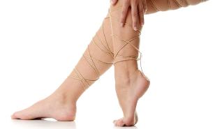 Varicose veins in the lower limbs