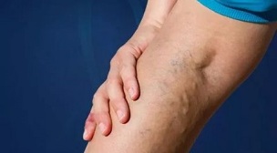 prevention of varicose veins