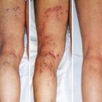 Varicose veins in the legs