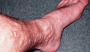 the cause of varicose veins in men's feet