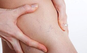 causes of varicose veins on the legs