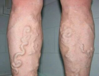 Grade 3 varicose veins in the legs