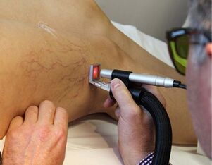 contraindications to laser treatment of varicose veins