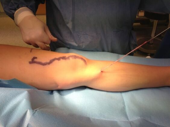 removal of varicose veins with varicose veins