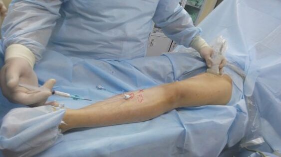 surgery for varicose veins in the legs