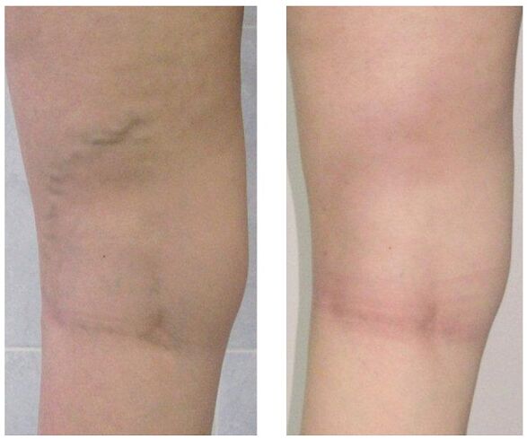 the vein in the leg before and after treating the varicose veins