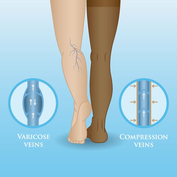 The effect of compression garments on varicose veins on the legs