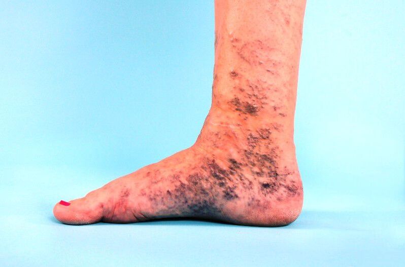 neglected varicose veins in the legs