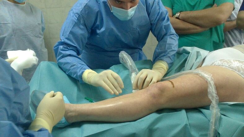 surgical treatment of varicose veins