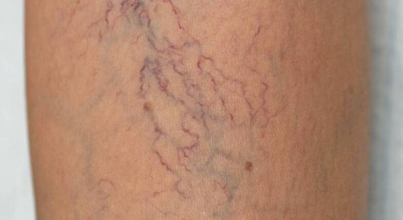 venous network for varicose veins