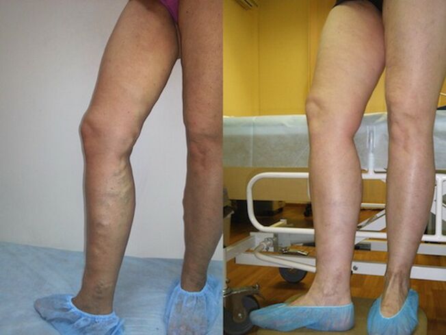 Legs before and after laser treatment of varicose veins