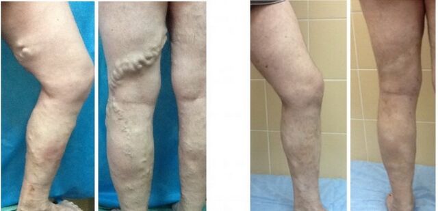 Legs before and after radiofrequency removal of varicose veins