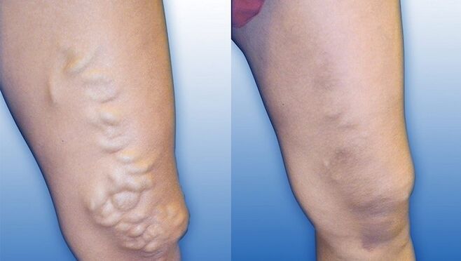 Legs before and after treatment of severe varicose veins