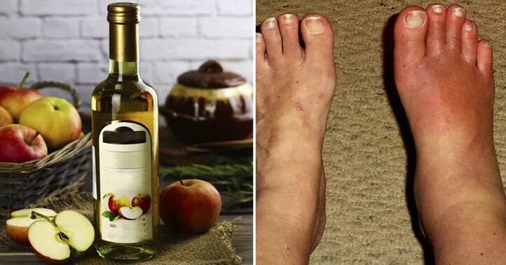apple cider vinegar against foot swelling