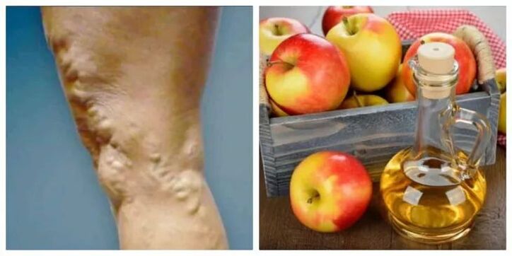 how to treat varicose veins with apple cider vinegar