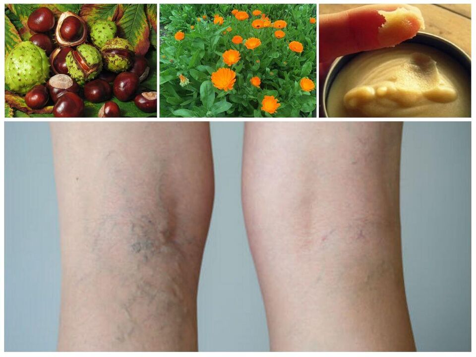 varicose veins on the legs and prevent folk remedies