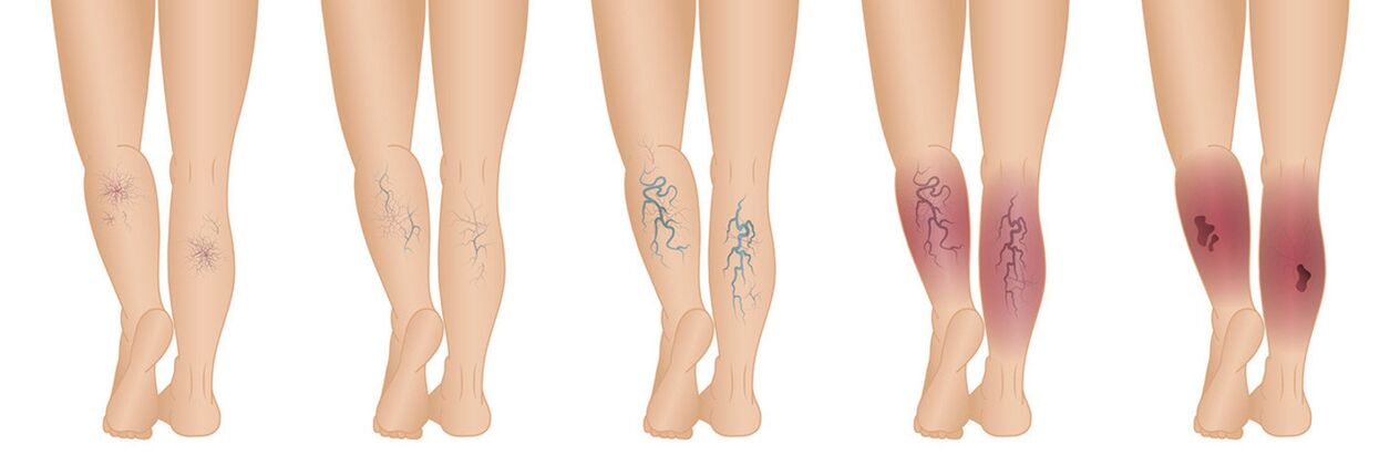 Stages of varicose veins in the lower extremities