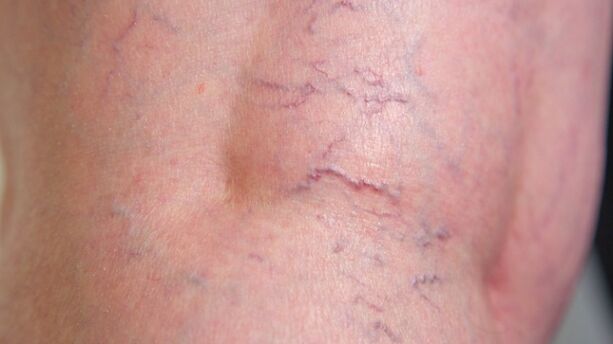 Signs of reticular varicose veins in the lower extremities - dilation of the fine veins and vascular network