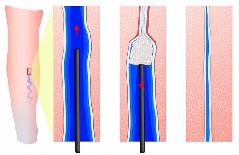 sclerotherapy for the treatment of varicose veins in men