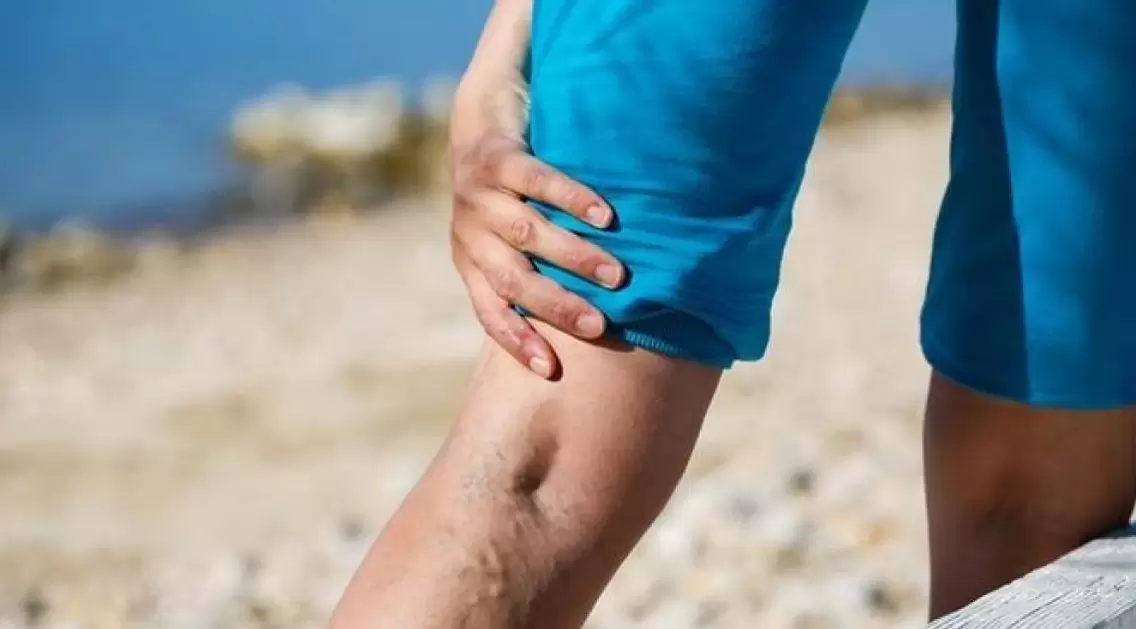 Blue veins bulging in the legs are signs of varicose veins
