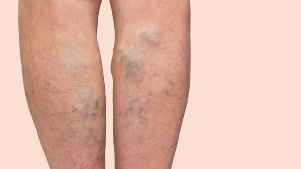 varicose veins