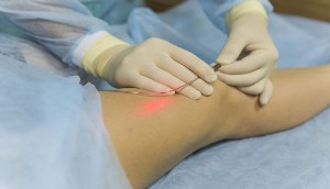 The treatment of varicose veins