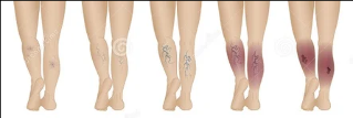 Varicose veins of the lower extremities stage of the